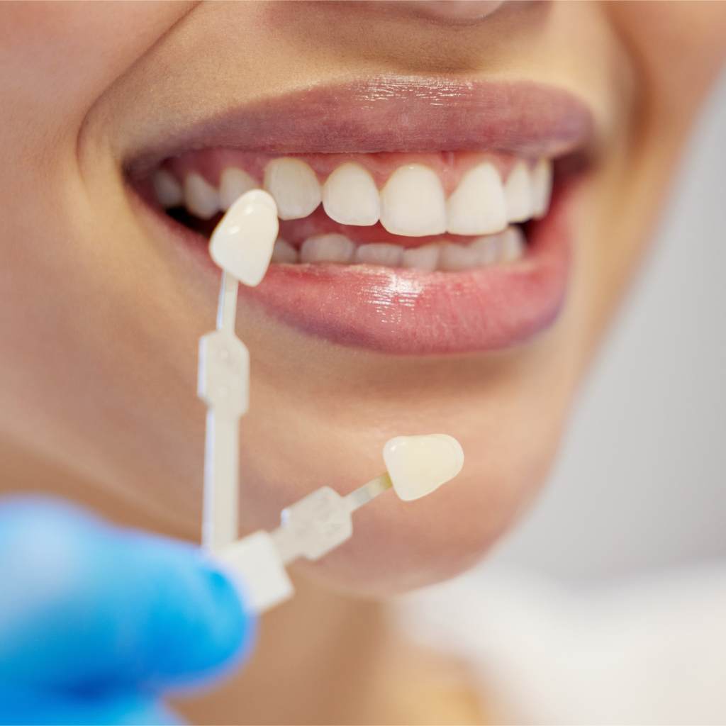 veneers vs bonding