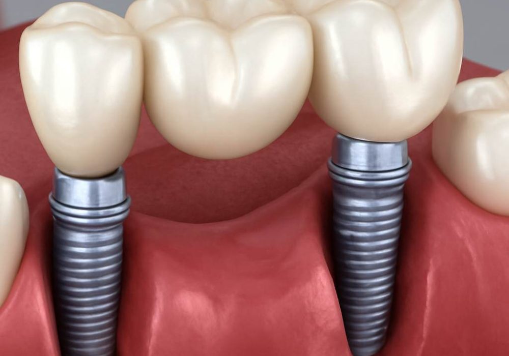 dental implants jackson ms