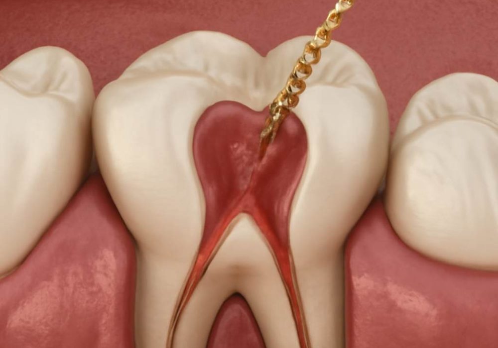 emergency root canal treatment
