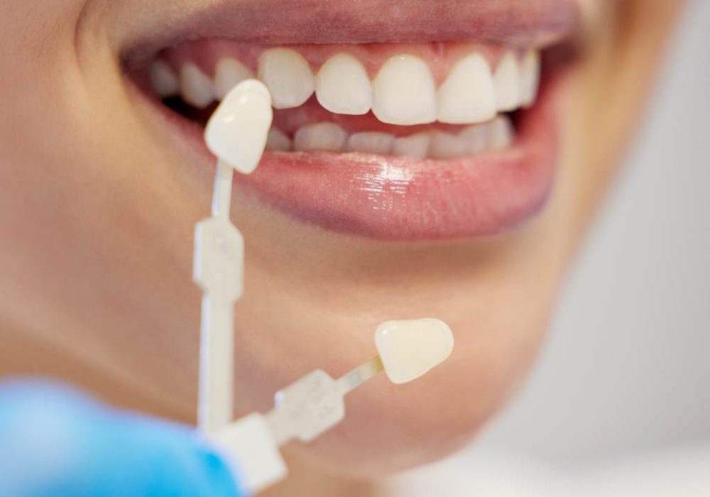 veneers vs bonding